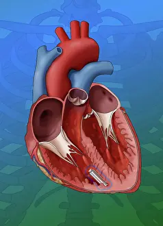 Device Prints: Leadless Pacemaker, Illustration