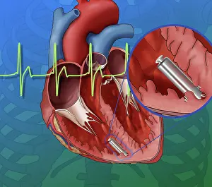 Leadless Pacemaker, Illustration