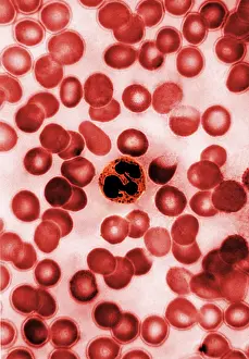 Stick Prints: Leukocyte, Drumstick, light micrograph