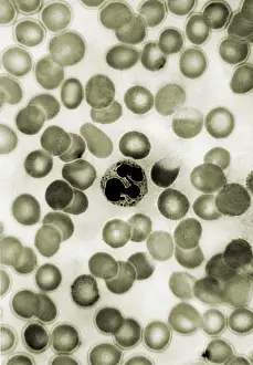 Stick Prints: Leukocyte, Drumstick, light micrograph