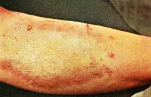 Arms Prints: Lichen Simplex Chronicus