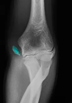 Year Prints: Little League Elbow Syndrome