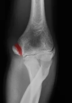 Year Prints: Little League Elbow Syndrome