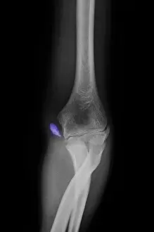 Year Prints: Little League Elbow Syndrome