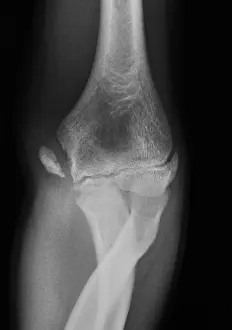 Abnormal Prints: Little League Elbow Syndrome