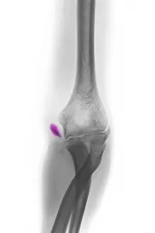 Abnormal Prints: Little League Elbow Syndrome