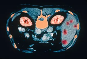 Tumor Prints: Liver Cancer, CT