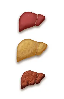 Progression Prints: Liver Disease Progression, Illustration