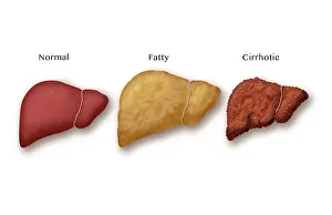 Progression Prints: Liver Disease Progression, Illustration