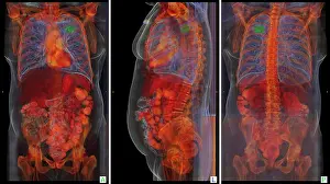 Patient Prints: Lung Cancer, 3D CT Scan