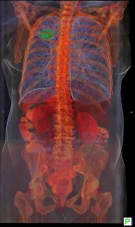 Patient Prints: Lung Cancer, 3D CT Scan