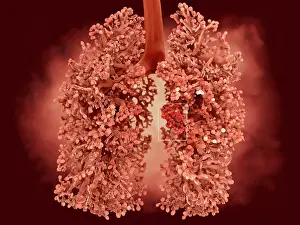 Pathological Prints: Lung cancer, artwork