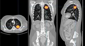 Section Prints: Lung Cancer, CT Scan
