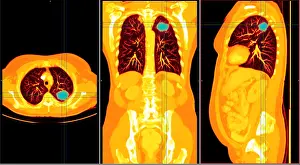 Tumor Prints: Lung Cancer, CT Scan