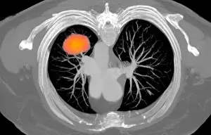 Tumor Prints: Lung Cancer, CT Scan