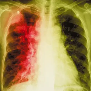 Chest Prints: Lung cancer x-ray