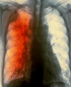 Chest Prints: Lung cancer x-ray