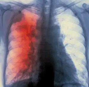 Research Prints: Lung cancer x-ray