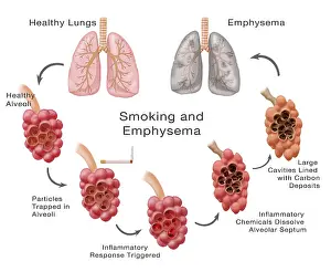 Smoke Prints: Lung Damage Leading to Emphysema