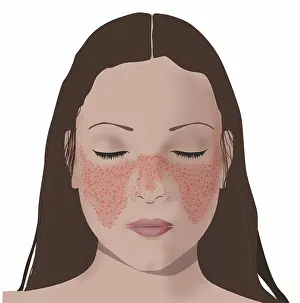 Womans Prints: Lupus or systemic lupus erythematosus (SLE) butterfly shaped rash on woman's face