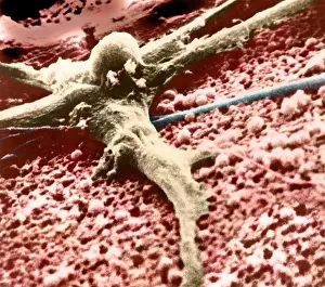 Malignancies Prints: Malignant cancer cell