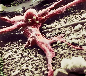 Malignancies Prints: Malignant cancer cell