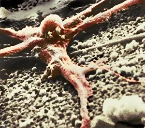 Malignancies Prints: Malignant cancer cell