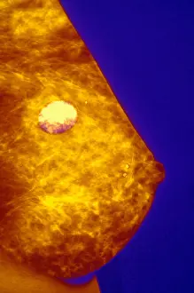 Breasts Prints: Mammogram