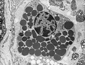 System Prints: Mast cell Tumor Under the Microscope, Cancer, TEM