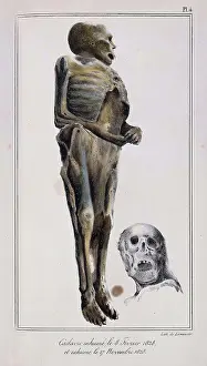 Court Prints: Mathieu Orfila, Decomposition On Exhumed Bodies, 1831