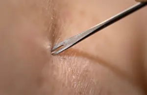 20th Prints: Medical Needle Piercing the Skin, Smallpox Vaccination, Bifurcated Needle
