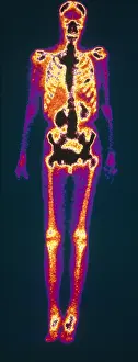 Nuclear Prints: Metastatic Lung Cancer