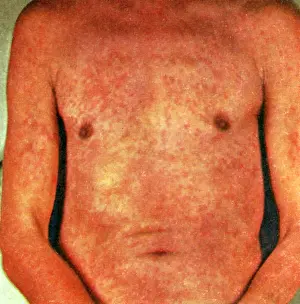 Heat Prints: Miliaria