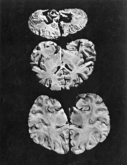 Neurological Prints: Minamata Disease