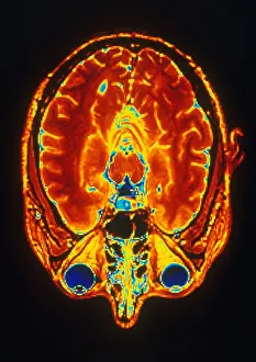 Magnetic Prints: MRI of Brain