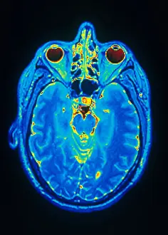 Magnetic Prints: MRI of Brain