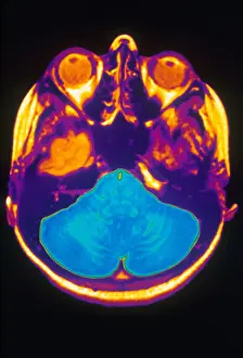 Magnetic Prints: MRI of Brain