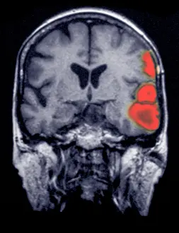 2005 Prints: MRI of brain showing a stroke