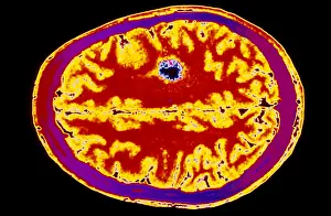 Malignancies Prints: MRI of brain tumor