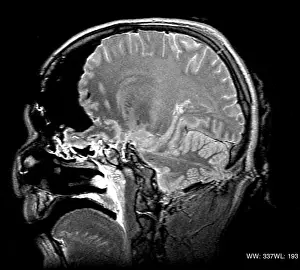 Medical Prints: MRI Cross Section, Wound Track