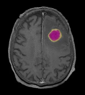 Abscess Prints: MRI of Encapsulated Abscess in Frontal Lobe