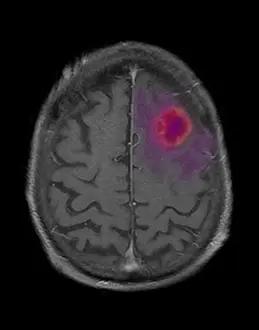 Abscess Prints: MRI of Encapsulated Abscess in Frontal Lobe