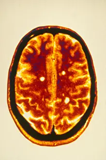 Magnetic Prints: MRI Multiple Sclerosis