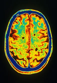 Magnetic Prints: MRI Multiple Sclerosis