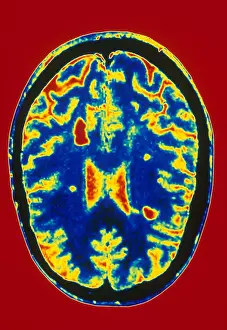 Magnetic Prints: MRI Multiple Sclerosis
