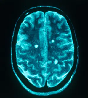 Magnetic Prints: MRI Multiple Sclerosis