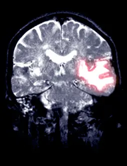 Magnetic Prints: MRI Scan of a Brain Hemorrhage