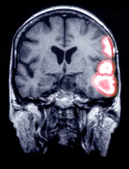 Magnetic Prints: MRI Scan of a Brain Hemorrhage