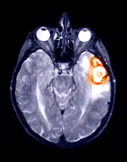 Magnetic Prints: MRI Scan of a Brain Hemorrhage