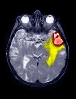 Magnetic Prints: MRI Scan of a Brain Hemorrhage